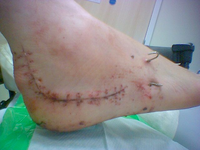 Stitches Removed